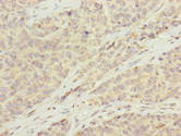 KCTD19 Antibody - Immunohistochemistry of paraffin-embedded human ovarian cancer using KCTD19 Antibody at dilution of 1:100