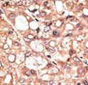 KDM1A / LSD1 Antibody - Formalin-fixed and paraffin-embedded human cancer tissue reacted with the primary antibody, which was peroxidase-conjugated to the secondary antibody, followed by DAB staining. This data demonstrates the use of this antibody for immunohistochemistry; clinical relevance has not been evaluated. BC = breast carcinoma; HC = hepatocarcinoma.