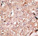 KDM1A / LSD1 Antibody - Formalin-fixed and paraffin-embedded human cancer tissue reacted with the primary antibody, which was peroxidase-conjugated to the secondary antibody, followed by DAB staining. This data demonstrates the use of this antibody for immunohistochemistry; clinical relevance has not been evaluated. BC = breast carcinoma; HC = hepatocarcinoma.