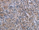KDM4D / JMJD2D Antibody - Immunohistochemistry of paraffin-embedded Human prostate cancer using KDM4D Polyclonal Antibody at dilution of 1:50.