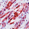 KDR / VEGFR2 / FLK1 Antibody - Formalin-fixed, paraffin-embedded human angiosarcoma stained with peroxidase-conjugate and AEC chromogen. Note cytoplasmic staining of tumor cells.  This image was taken for the unmodified form of this product. Other forms have not been tested.