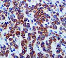 Keratin, LMW Antibody - IHC of Cytokeratin LMW CAM5.2 on FFPE Breast Carcinoma tissue.