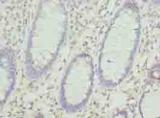 KHDRBS2 / SLM-1 Antibody - Immunohistochemistry of paraffin-embedded human colon cancer using antibody at dilution of 1:100.