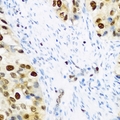KHDRBS2 / SLM-1 Antibody - Immunohistochemical analysis of SLM-1 staining in human prostate cancer formalin fixed paraffin embedded tissue section. The section was pre-treated using heat mediated antigen retrieval with sodium citrate buffer (pH 6.0). The section was then incubated with the antibody at room temperature and detected using an HRP conjugated compact polymer system. DAB was used as the chromogen. The section was then counterstained with hematoxylin and mounted with DPX.