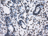 KIAA0153 / TTLL12 Antibody - Immunohistochemical staining of paraffin-embedded Adenocarcinoma of colon tissue using anti-TTLL12 mouse monoclonal antibody. (Dilution 1:50).