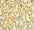 KIAA1324L Antibody - Immunohistochemistry of paraffin-embedded human gastric cancer using KIAA1324L Antibody at dilution of 1:100