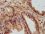 KIF13B / GAKIN Antibody - Immunohistochemistry image at a dilution of 1:400 and staining in paraffin-embedded human prostate cancer performed on a Leica BondTM system.