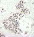 KIF14 Antibody - Detection of Human KIF14 by Immunohistochemistry. Sample: FFPE section of human breast carcinoma. Antibody: Affinity purified rabbit anti-KIF14 used at a dilution of 1:250. Epitope Retrieval Buffer-High pH (IHC-101J) was substituted for Epitope Retrieval Buffer-Reduced pH.