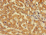 KIF17 Antibody - Immunohistochemistry of paraffin-embedded human liver cancer at dilution of 1:100