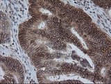KIF25 Antibody - IHC of paraffin-embedded Adenocarcinoma of Human colon tissue using anti-KIF25 mouse monoclonal antibody. (Heat-induced epitope retrieval by 10mM citric buffer, pH6.0, 100C for 10min).