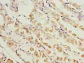 KIF26B Antibody - Immunohistochemistry of paraffin-embedded human gastric cancer using antibody at dilution of 1:100.