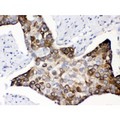KIN17 / KIN Antibody - KIN antibody IHC-paraffin. IHC(P): Human Esophagus Squama Cancer Tissue.