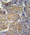 KIR2DS2 / CD158j Antibody - KIR2DS2 Antibody immunohistochemistry of formalin-fixed and paraffin-embedded human skin carcinoma followed by peroxidase-conjugated secondary antibody and DAB staining.