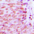 Antibody - Immunohistochemical analysis of KLF10/11 staining in human prostate cancer formalin fixed paraffin embedded tissue section. The section was pre-treated using heat mediated antigen retrieval with sodium citrate buffer (pH 6.0). The section was then incubated with the antibody at room temperature and detected using an HRP conjugated compact polymer system. DAB was used as the chromogen. The section was then counterstained with hematoxylin and mounted with DPX.