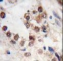 KLF4 Antibody - Formalin-fixed and paraffin-embedded human prostate carcinoma tissue reacted with KLF4 antibody (N-term C74) , which was peroxidase-conjugated to the secondary antibody, followed by DAB staining. This data demonstrates the use of this antibody for immunohistochemistry; clinical relevance has not been evaluated.