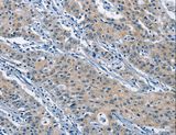 KLF7 Antibody - Immunohistochemistry of paraffin-embedded Human gastric cancer using KLF7 Polyclonal Antibody at dilution of 1:60.