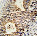 KLHL24 Antibody - KLHL24 Antibody immunohistochemistry of formalin-fixed and paraffin-embedded human colon carcinoma followed by peroxidase-conjugated secondary antibody and DAB staining.