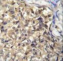 KLHL35 Antibody - KLHL35 Antibody immunohistochemistry of formalin-fixed and paraffin-embedded human breast carcinoma followed by peroxidase-conjugated secondary antibody and DAB staining.