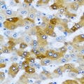 KLK10 / Kallikrein 10 Antibody - Immunohistochemical analysis of KLK10 staining in human liver cancer formalin fixed paraffin embedded tissue section. The section was pre-treated using heat mediated antigen retrieval with sodium citrate buffer (pH 6.0). The section was then incubated with the antibody at room temperature and detected using an HRP conjugated compact polymer system. DAB was used as the chromogen. The section was then counterstained with hematoxylin and mounted with DPX.
