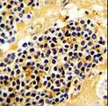 KLRC1 / NKG2A / CD159a Antibody - Formalin-fixed and paraffin-embedded human kidney carcinoma with KLRC1 Antibody , which was peroxidase-conjugated to the secondary antibody, followed by DAB staining. This data demonstrates the use of this antibody for immunohistochemistry; clinical relevance has not been evaluated.