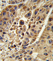 KMO Antibody - Formalin-fixed and paraffin-embedded human hepatocarcinoma reacted with KMO Antibody , which was peroxidase-conjugated to the secondary antibody, followed by DAB staining. This data demonstrates the use of this antibody for immunohistochemistry; clinical relevance has not been evaluated.