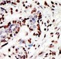 KMT2A / MLL Antibody - Formalin-fixed and paraffin-embedded human cancer tissue reacted with the primary antibody, which was peroxidase-conjugated to the secondary antibody, followed by AEC staining. This data demonstrates the use of this antibody for immunohistochemistry; clinical relevance has not been evaluated. BC = breast carcinoma; HC = hepatocarcinoma.