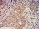 KMT2C / MLL3 Antibody - Immunohistochemical analysis of paraffin-embedded cervical cancer tissues using KMT2C mouse mAb with DAB staining.