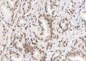 KMT2D / MLL2 Antibody - 1:100 staining human Prostate carcinoma tissue by IHC-P. The tissue was formaldehyde fixed and a heat mediated antigen retrieval step in citrate buffer was performed. The tissue was then blocked and incubated with the antibody for 1.5 hours at 22°C. An HRP conjugated goat anti-rabbit antibody was used as the secondary.