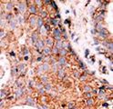 KPI-2 / LMTK2 Antibody - Formalin-fixed and paraffin-embedded human cancer tissue reacted with the primary antibody, which was peroxidase-conjugated to the secondary antibody, followed by DAB staining. This data demonstrates the use of this antibody for immunohistochemistry; clinical relevance has not been evaluated. BC = breast carcinoma; HC = hepatocarcinoma.