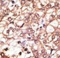 KREMEN1 / KREMEN-1 Antibody - Formalin-fixed and paraffin-embedded human cancer tissue reacted with the primary antibody, which was peroxidase-conjugated to the secondary antibody, followed by AEC staining. This data demonstrates the use of this antibody for immunohistochemistry; clinical relevance has not been evaluated. BC = breast carcinoma; HC = hepatocarcinoma.