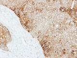 KRT13 / CK13 / Cytokeratin 13 Antibody - IHC of paraffin-embedded Cal27 xenograft using Cytokeratin 13 antibody at 1:500 dilution.