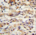 KRT14 / CK14 / Cytokeratin 14 Antibody - Formalin-fixed and paraffin-embedded human breast carcinoma with KRT14 Antibody , which was peroxidase-conjugated to the secondary antibody, followed by DAB staining. This data demonstrates the use of this antibody for immunohistochemistry; clinical relevance has not been evaluated.