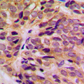 KRT16 / CK16 / Cytokeratin 16 Antibody - Immunohistochemical analysis of Cytokeratin 16 staining in human breast cancer formalin fixed paraffin embedded tissue section. The section was pre-treated using heat mediated antigen retrieval with sodium citrate buffer (pH 6.0). The section was then incubated with the antibody at room temperature and detected using an HRP conjugated compact polymer system. DAB was used as the chromogen. The section was then counterstained with hematoxylin and mounted with DPX.