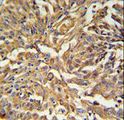 KRT19 / CK19 / Cytokeratin 19 Antibody - KRT19 Antibody IHC of formalin-fixed and paraffin-embedded human Lung carcinoma followed by peroxidase-conjugated secondary antibody and DAB staining.