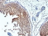 KRT6 / CK6 / Cytokeratin 6 Antibody - Formalin-fixed, paraffin-embedded human bladder carcinoma stained with Cytokeratin 6 antibody (SPM269).  This image was taken for the unmodified form of this product. Other forms have not been tested.