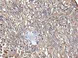 KRT73 / Keratin 73 Antibody - Immunohistochemistry of paraffin-embedded Human lung cancer tissue  using KRT73 Polyclonal Antibody at dilution of 1:55(×200)