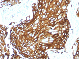 KRT77 / Keratin 77 / KRT1B Antibody - Formalin-fixed, paraffin-embedded human Lung Carcinoma stained with CK LMW Rabbit Recombinant Monoclonal Antibody (KRTL/1577R).