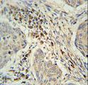 KXD1 / C19orf50 Antibody - C19orf50 Antibody immunohistochemistry of formalin-fixed and paraffin-embedded human lung carcinoma followed by peroxidase-conjugated secondary antibody and DAB staining.