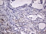 KYNU Antibody - IHC of paraffin-embedded Carcinoma of Human lung tissue using anti-KYNU mouse monoclonal antibody. (Heat-induced epitope retrieval by 1 mM EDTA in 10mM Tris, pH8.5, 120°C for 3min).
