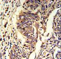 KYNU Antibody - Formalin-fixed and paraffin-embedded human lung carcinoma reacted with KYNU Antibody , which was peroxidase-conjugated to the secondary antibody, followed by DAB staining. This data demonstrates the use of this antibody for immunohistochemistry; clinical relevance has not been evaluated.