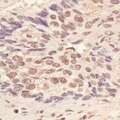 L3MBTL3 Antibody - Detection of Human L3MBTL3 by Immunohistochemistry. Sample: FFPE section of human lung carcinoma. Antibody: Affinity purified rabbit anti-L3MBTL3 used at a dilution of 1:1000 (1 ug/ml). Detection: Vector Laboratories ImmPACT NovaRED Peroxidase Substrate.