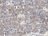 LACTB2 Antibody - IHC of paraffin-embedded Carcinoma of Human thyroid tissue using anti-LACTB2 mouse monoclonal antibody.