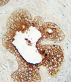 LAG3 Antibody - LAG3 Antibody immunohistochemistry of formalin-fixed and paraffin-embedded human prostate carcinoma followed by peroxidase-conjugated secondary antibody and DAB staining.