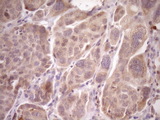 LAG3 Antibody - IHC of paraffin-embedded Adenocarcinoma of Human ovary tissue using anti-LAG3 mouse monoclonal antibody. (Heat-induced epitope retrieval by Tris-EDTA, pH8.0)(1:150).