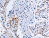 LAIR1 / CD305 Antibody - Immunohistochemistry of paraffin-embedded Human breast cancer using LAIR1 Polyclonal Antibody at dilution of 1:25.