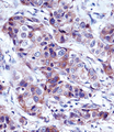 LALBA / Alpha Lactalbumin Antibody - LALBA Antibody immunohistochemistry of formalin-fixed and paraffin-embedded human breast carcinoma followed by peroxidase-conjugated secondary antibody and DAB staining.