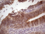 LAMA4 / Laminin Alpha 4 Antibody - Immunohistochemical staining of paraffin-embedded Adenocarcinoma of Human colon tissue using anti-LAMA4 mouse monoclonal antibody.  heat-induced epitope retrieval by 1 mM EDTA in 10mM Tris, pH8.5, 120C for 3min)