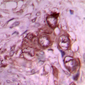 LAMB1 / Laminin Beta 1 Antibody - Immunohistochemical analysis of Laminin beta 1 staining in human breast cancer formalin fixed paraffin embedded tissue section. The section was pre-treated using heat mediated antigen retrieval with sodium citrate buffer (pH 6.0). The section was then incubated with the antibody at room temperature and detected using an HRP conjugated compact polymer system. DAB was used as the chromogen. The section was then counterstained with hematoxylin and mounted with DPX.