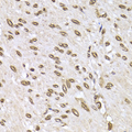 LAMB2 / Laminin Beta 2 Antibody - Immunohistochemistry of paraffin-embedded human colon cancer tissue.