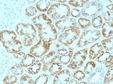 LAMC1 / Laminin Gamma 1 Antibody - Formalin-fixed, paraffin-embedded human renal cell carcinoma stained with Laminin gamma 1 antibody (SPM193).  This image was taken for the unmodified form of this product. Other forms have not been tested.